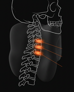 11_medical_cervical_decompression.png